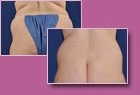 Aspen Combi Lipo, vorher und nachher, Fall 2