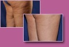 Aspen Combi Lipo, vorher und nachher, Fall 4