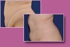 Aspen Combi Lipo, vorher und nachher, Fall 5