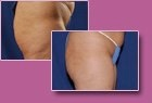 Aspen Combi Lipo, vorher und nachher, Fall 7